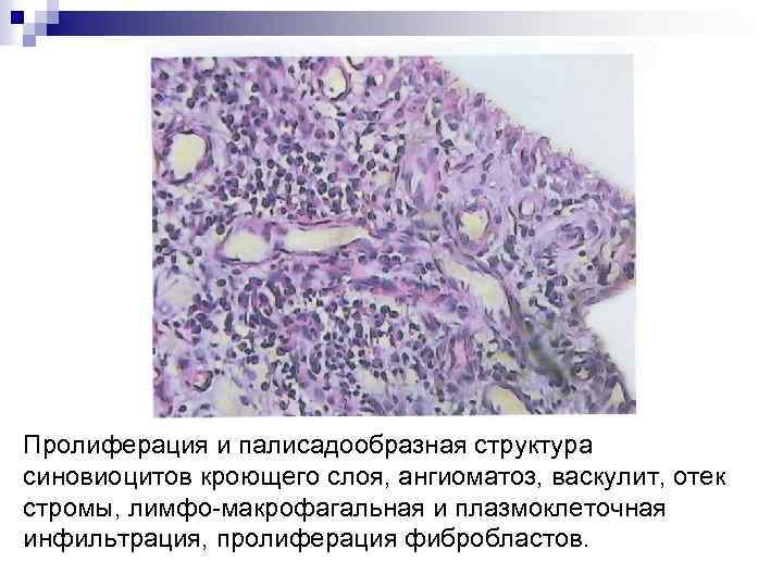 Пролиферация и палисадообразная структура синовиоцитов кроющего слоя, ангиоматоз, васкулит, отек стромы, лимфо-макрофагальная и плазмоклеточная