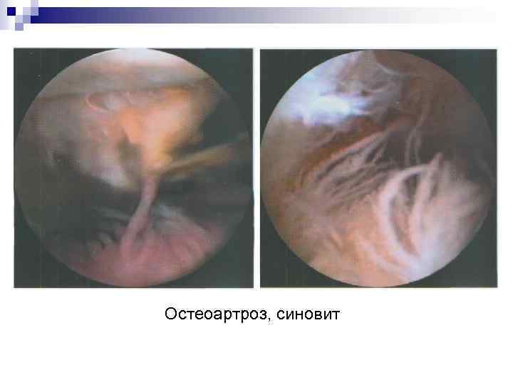 Остеоартроз, синовит 
