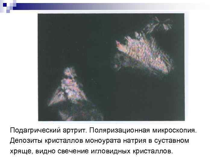 Подагрический артрит. Поляризационная микроскопия. Депозиты кристаллов моноурата натрия в суставном хряще, видно свечение игловидных