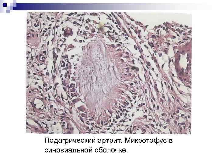 Подагрический артрит. Микротофус в синовиальной оболочке. 