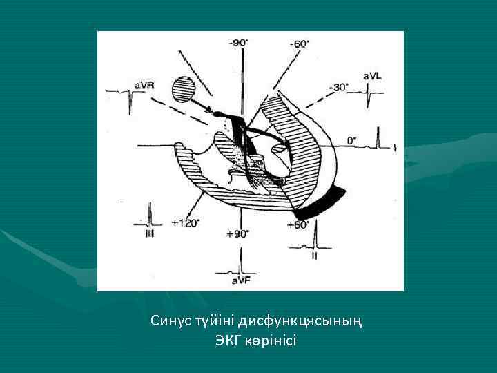 Синус түйіні дисфункцясының ЭКГ көрінісі 