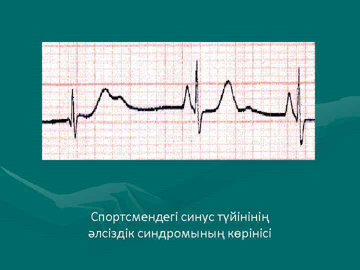 Спортсмендегі синус түйінінің әлсіздік синдромының көрінісі 