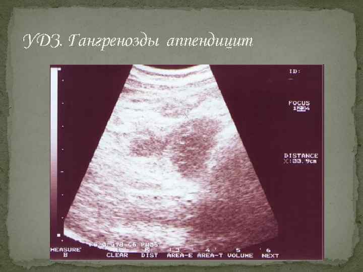 УДЗ. Гангренозды аппендицит 