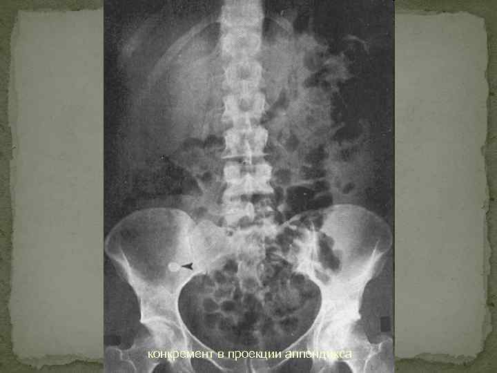 конкремент в проекции аппендикса 