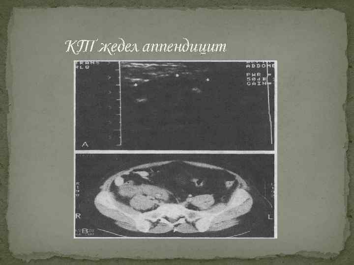 КТ жедел аппендицит 