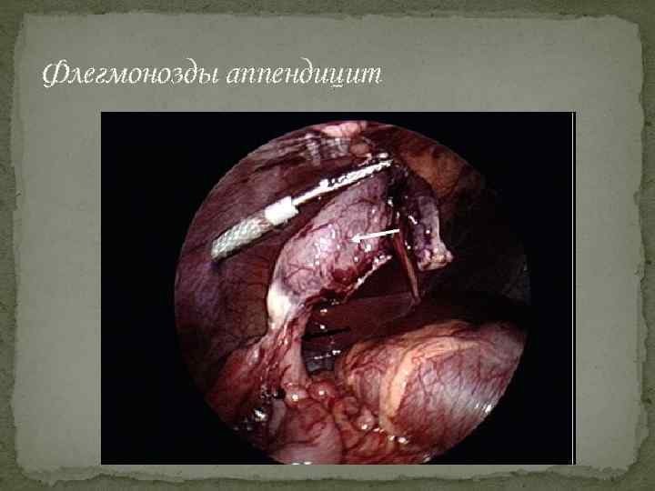 Флегмонозды аппендицит 