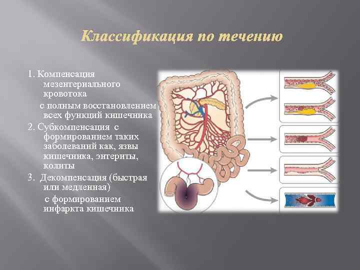 Классификация по течению 1. Компенсация мезентериального кровотока с полным восстановлением всех функций кишечника 2.