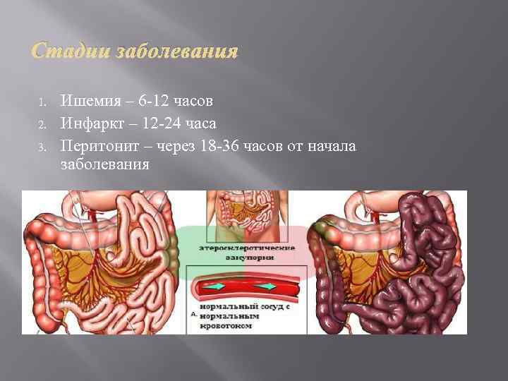 Стадии заболевания 1. 2. 3. Ишемия – 6 -12 часов Инфаркт – 12 -24