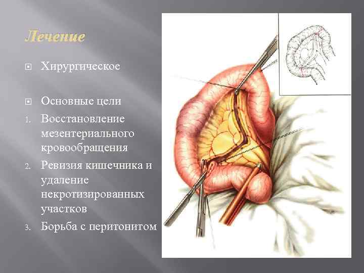 Лечение Хирургическое Основные цели Восстановление мезентериального кровообращения Ревизия кишечника и удаление некротизированных участков Борьба