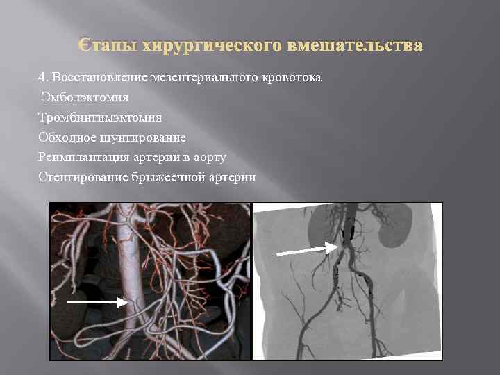 Этапы хирургического вмешательства 4. Восстановление мезентериального кровотока Эмболэктомия Тромбинтимэктомия Обходное шунтирование Реимплантация артерии в