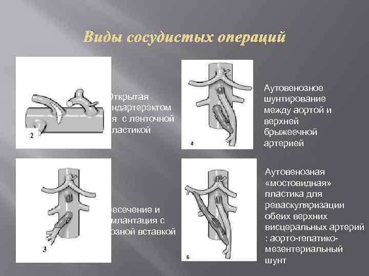 Виды сосудистых операций Открытая эндартерэктом ия с ленточной пластикой Пересечение и реимлантация с венозной