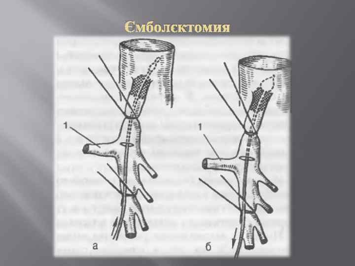 Эмболэктомия 