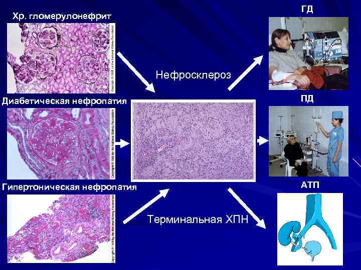 ГД Хр. гломерулонефрит Нефросклероз Диабетическая нефропатия ПД Гипертоническая нефропатия АТП Терминальная ХПН 