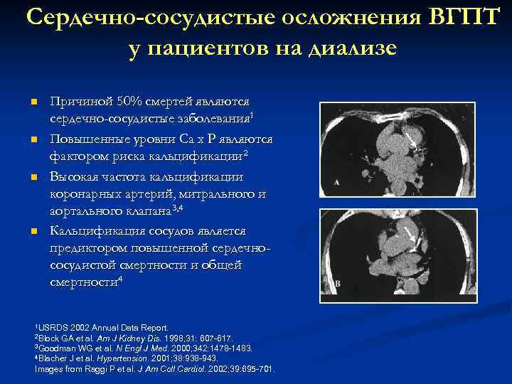 Сердечно-сосудистые осложнения ВГПТ у пациентов на диализе n n Причиной 50% смертей являются сердечно-сосудистые