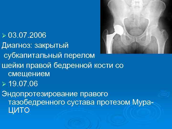 Мкб перелом бедренной. Закрытый субкапитальный перелом шейки правой бедренной кости. Субкапитальный перелом шейки правой бедренной кости. Перелом шейки бедра диагноз. Перелом шейки бедра формулировка диагноза.