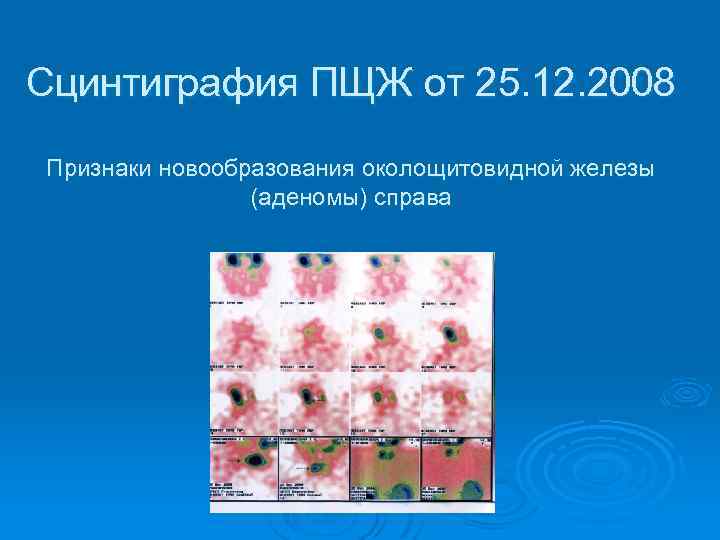 Сцинтиграфия ПЩЖ от 25. 12. 2008 Признаки новообразования околощитовидной железы (аденомы) справа 
