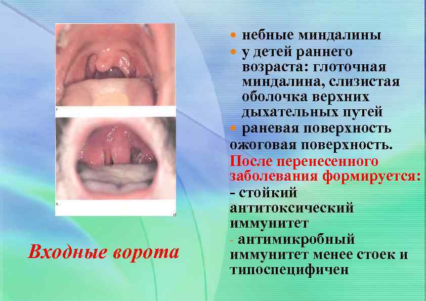 небные миндалины у детей раннего возраста: глоточная миндалина, слизистая оболочка верхних дыхательных путей раневая