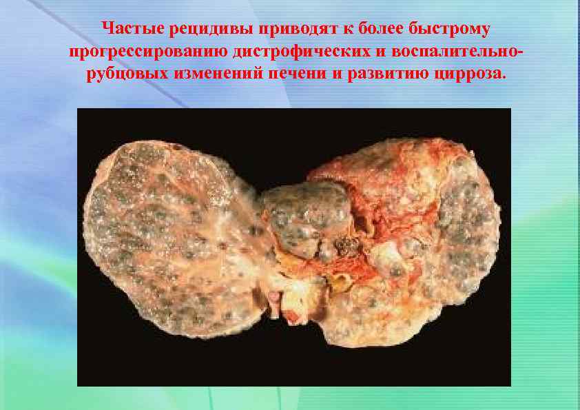 Частые рецидивы приводят к более быстрому прогрессированию дистрофических и воспалительнорубцовых изменений печени и развитию