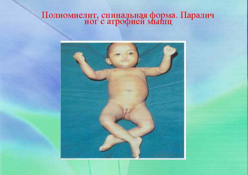 Полиомиелит, спинальная форма. Паралич ног с атрофией мышц 