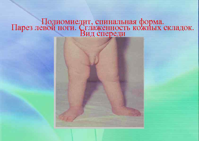 Полиомиелит, спинальная форма. Парез левой ноги. Сглаженность кожных складок. Вид спереди 