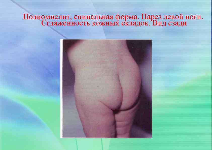 Полиомиелит, спинальная форма. Парез левой ноги. Сглаженность кожных складок. Вид сзади 