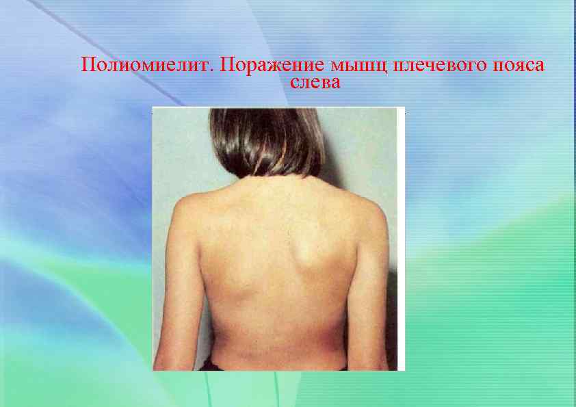 Полиомиелит. Поражение мышц плечевого пояса слева 