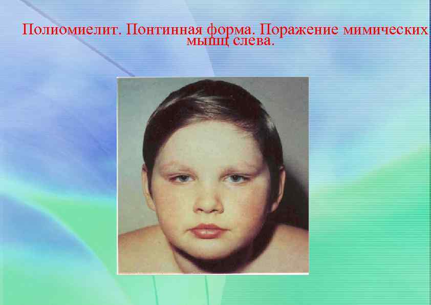 Полиомиелит. Понтинная форма. Поражение мимических мышц слева. 