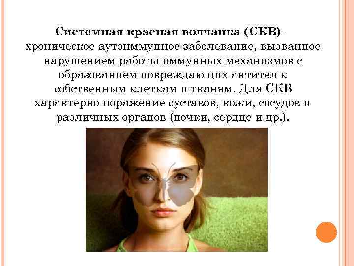 Системная красная волчанка (СКВ) – хроническое аутоиммунное заболевание, вызванное нарушением работы иммунных механизмов с