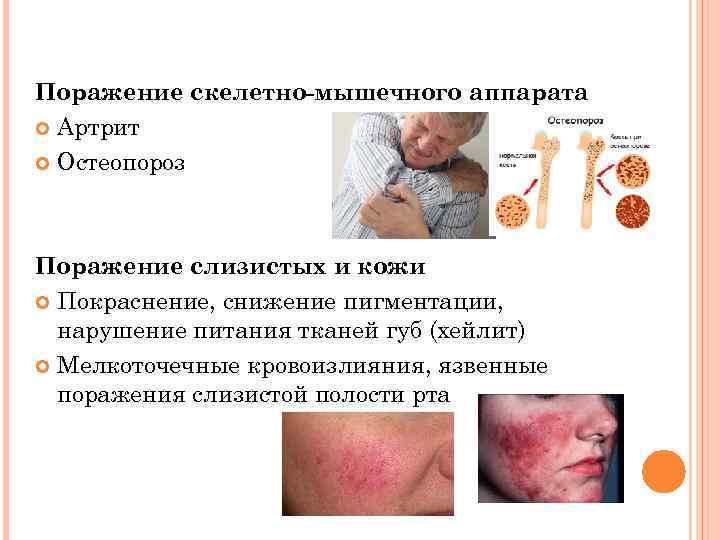 Поражение скелетно-мышечного аппарата Артрит Остеопороз Поражение слизистых и кожи Покраснение, снижение пигментации, нарушение питания