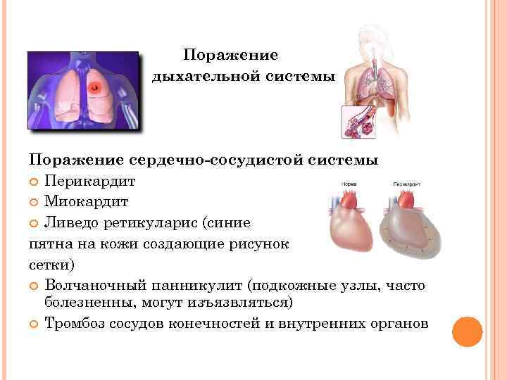 Поражение дыхательной системы Поражение сердечно-сосудистой системы Перикардит Миокардит Ливедо ретикуларис (синие пятна на кожи