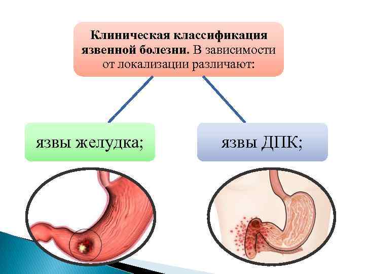 Клиническая классификация язвенной болезни. В зависимости от локализации различают: язвы желудка; язвы ДПК; 
