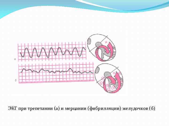 ЭКГ при трепетании (а) и мерцании (фибрилляции) желудочков (б) 