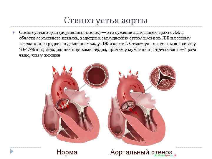 Стеноз устья аорты (аортальный стеноз) — это сужение выносящего тракта ЛЖ в области аортального