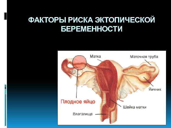 ФАКТОРЫ РИСКА ЭКТОПИЧЕСКОЙ БЕРЕМЕННОСТИ 