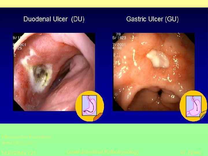 Helicobacter Foundation www. helico. com NURSING 621 Gastrointestinal Pathohysiology W. Rose 