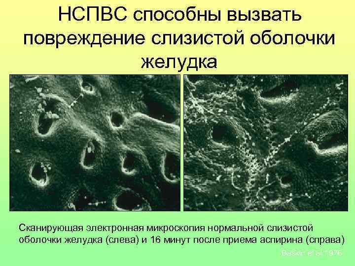 НСПВС способны вызвать повреждение слизистой оболочки желудка Сканирующая электронная микроскопия нормальной слизистой оболочки желудка