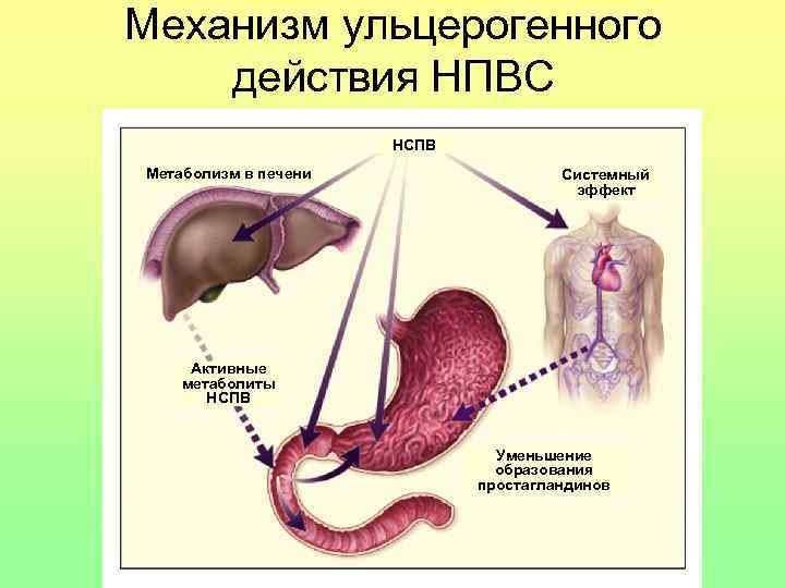 Механизм ульцерогенного действия НПВС НСПВ Метаболизм в печени Системный эффект Активные метаболиты НСПВ Уменьшение