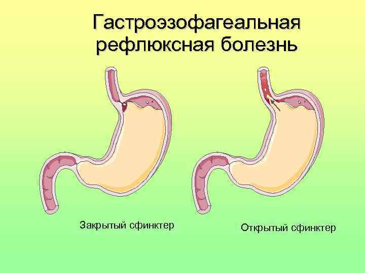 Гастроэзофагеальная рефлюксная болезнь Закрытый сфинктер Открытый сфинктер 