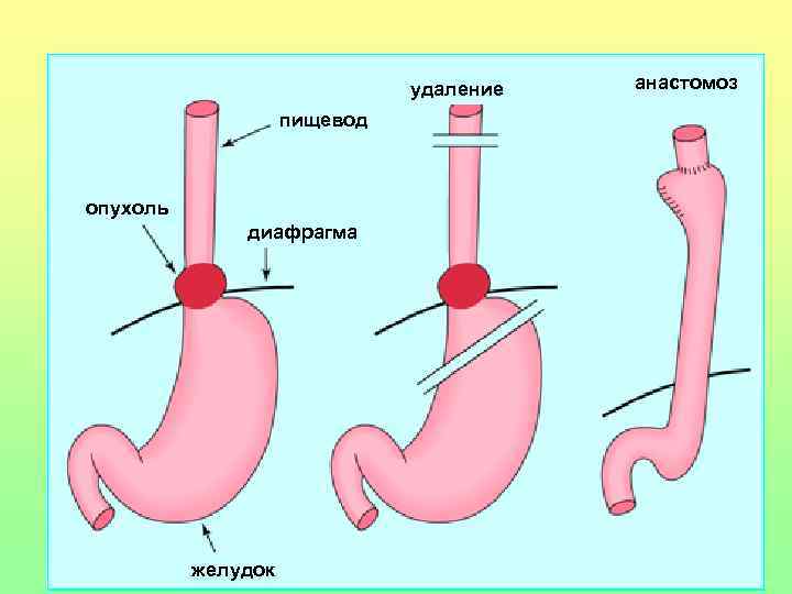 удаление пищевод опухоль диафрагма желудок анастомоз 