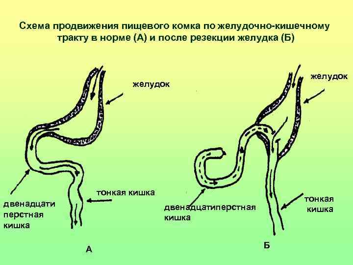 Схема продвижения пищевого комка по желудочно-кишечному тракту в норме (А) и после резекции желудка