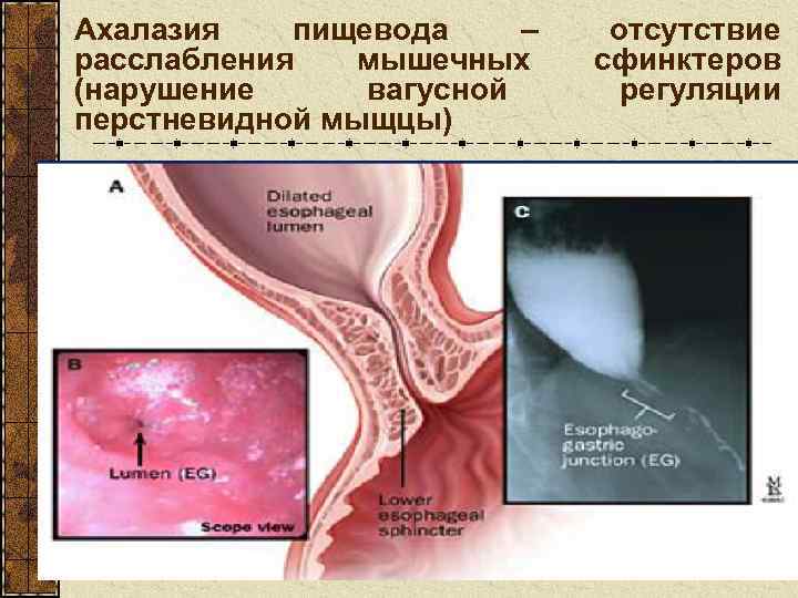 Ахалазия пищевода – расслабления мышечных (нарушение вагусной перстневидной мыщцы) отсутствие сфинктеров регуляции 