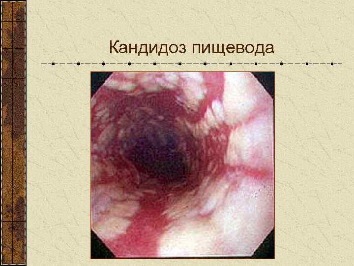 Кандидоз пищевода 