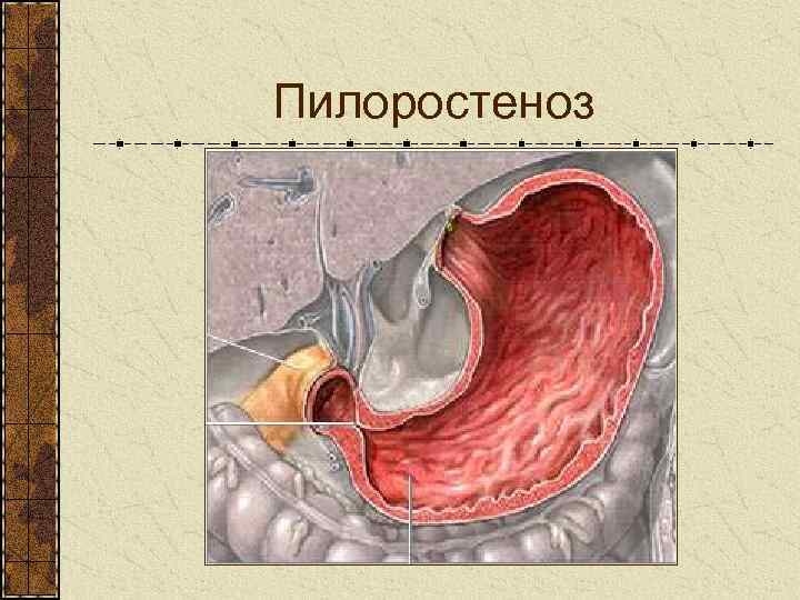 Пилоростеноз врожденный презентация