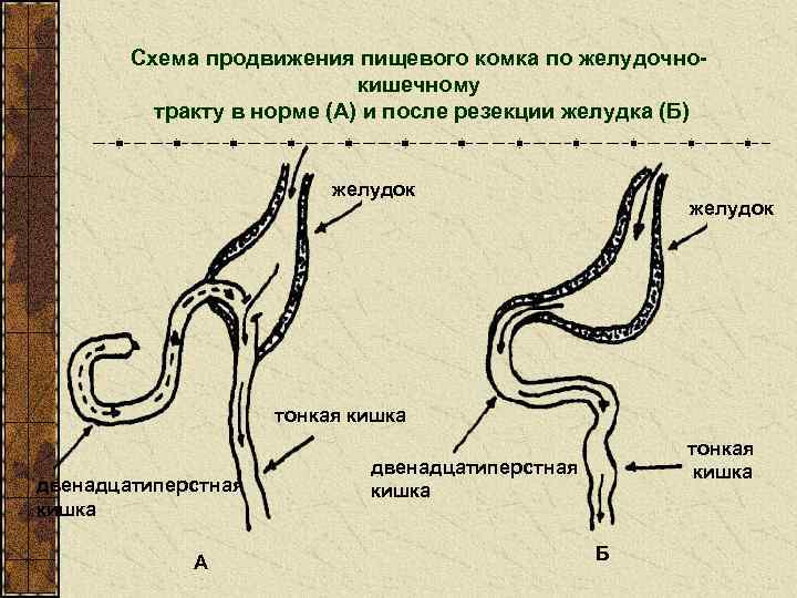 Схема продвижения пищевого комка по желудочнокишечному тракту в норме (А) и после резекции желудка