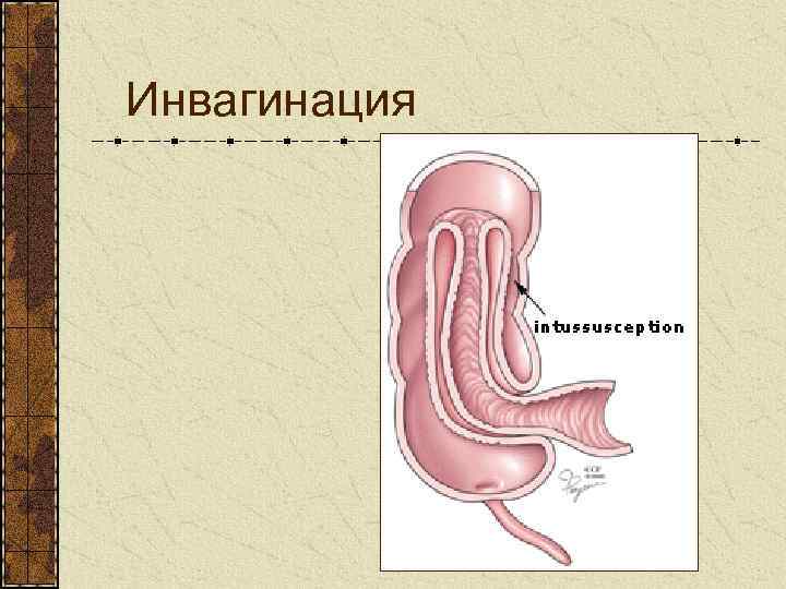 Инвагинация 