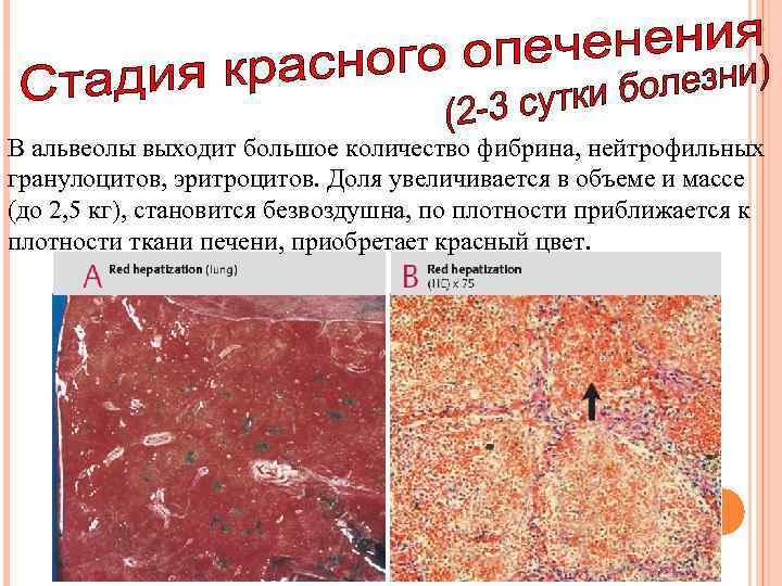 В альвеолы выходит большое количество фибрина, нейтрофильных гранулоцитов, эритроцитов. Доля увеличивается в объеме и