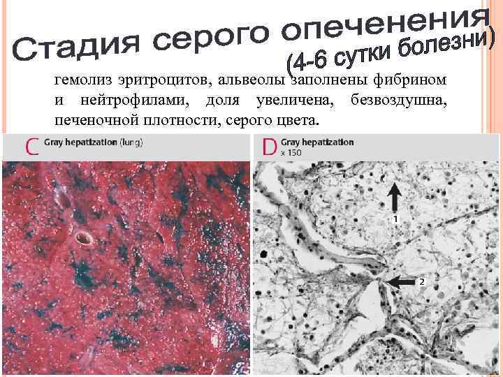 гемолиз эритроцитов, альвеолы заполнены фибрином и нейтрофилами, доля увеличена, безвоздушна, печеночной плотности, серого цвета.