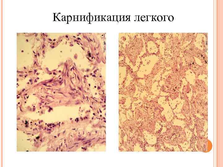 Карнификация легкого 