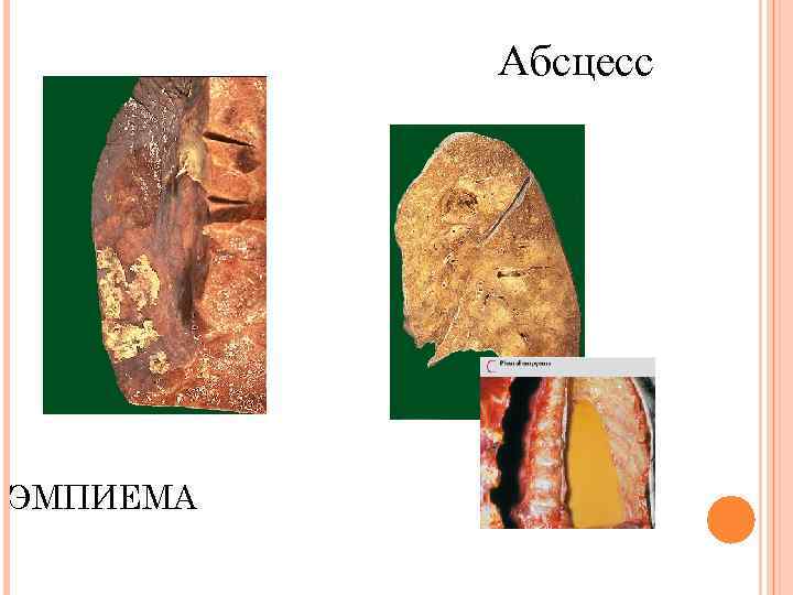 Абсцесс ЭМПИЕМА 