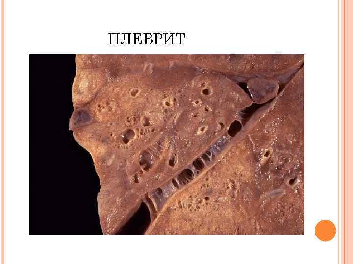 ПЛЕВРИТ 